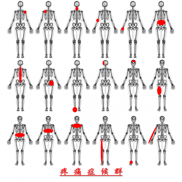 疼痛症候群18種圖片1.png